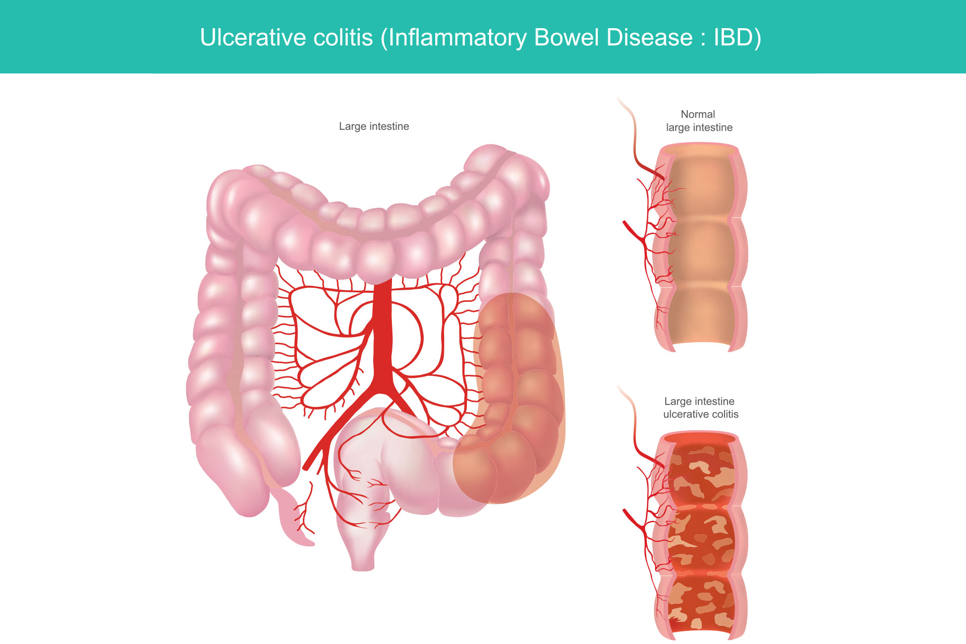 Nutricionista especialista en colitis ulcerosa